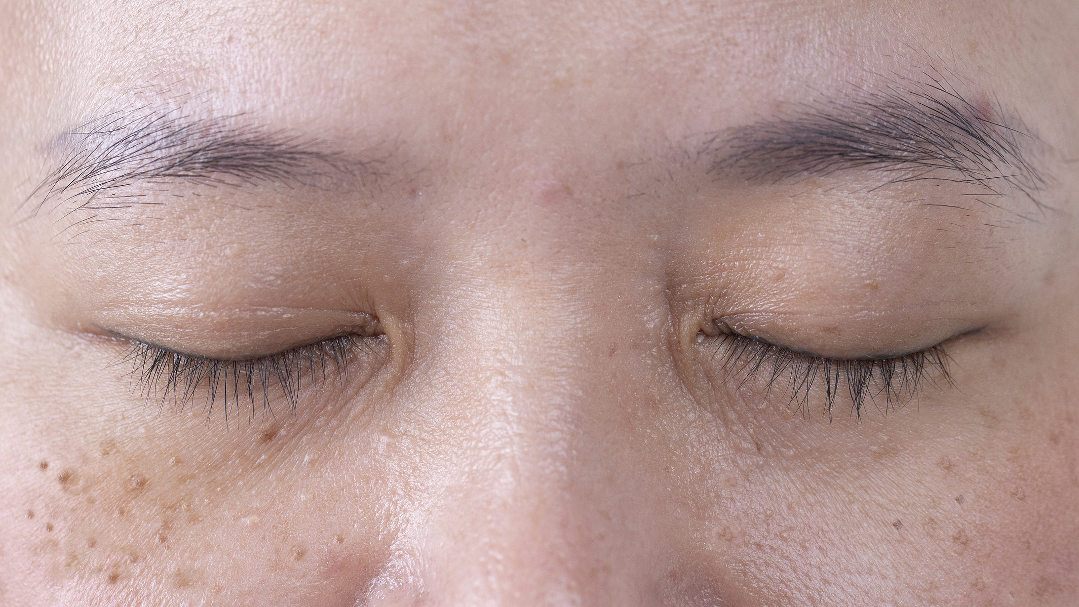 黄褐斑越祛越黑？