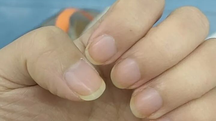 指甲出现3种迹象，尿酸可能高到“肾坏了”都不知道！赶紧自查→