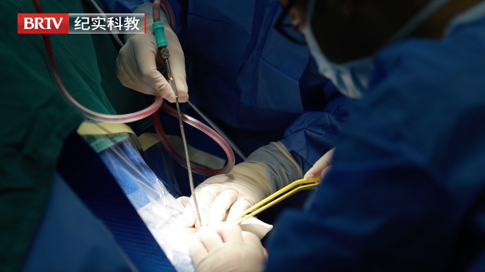 这项技术为癫痫病患者和家属解开“枷锁” 这项技术为癫痫病患者和家属解开“枷锁”
