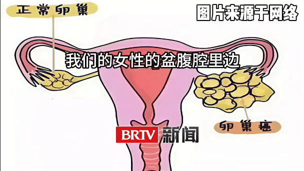 卵巢癌为什么是“最阴险”的肿瘤？一旦患癌就会“像蒲公英般散开”