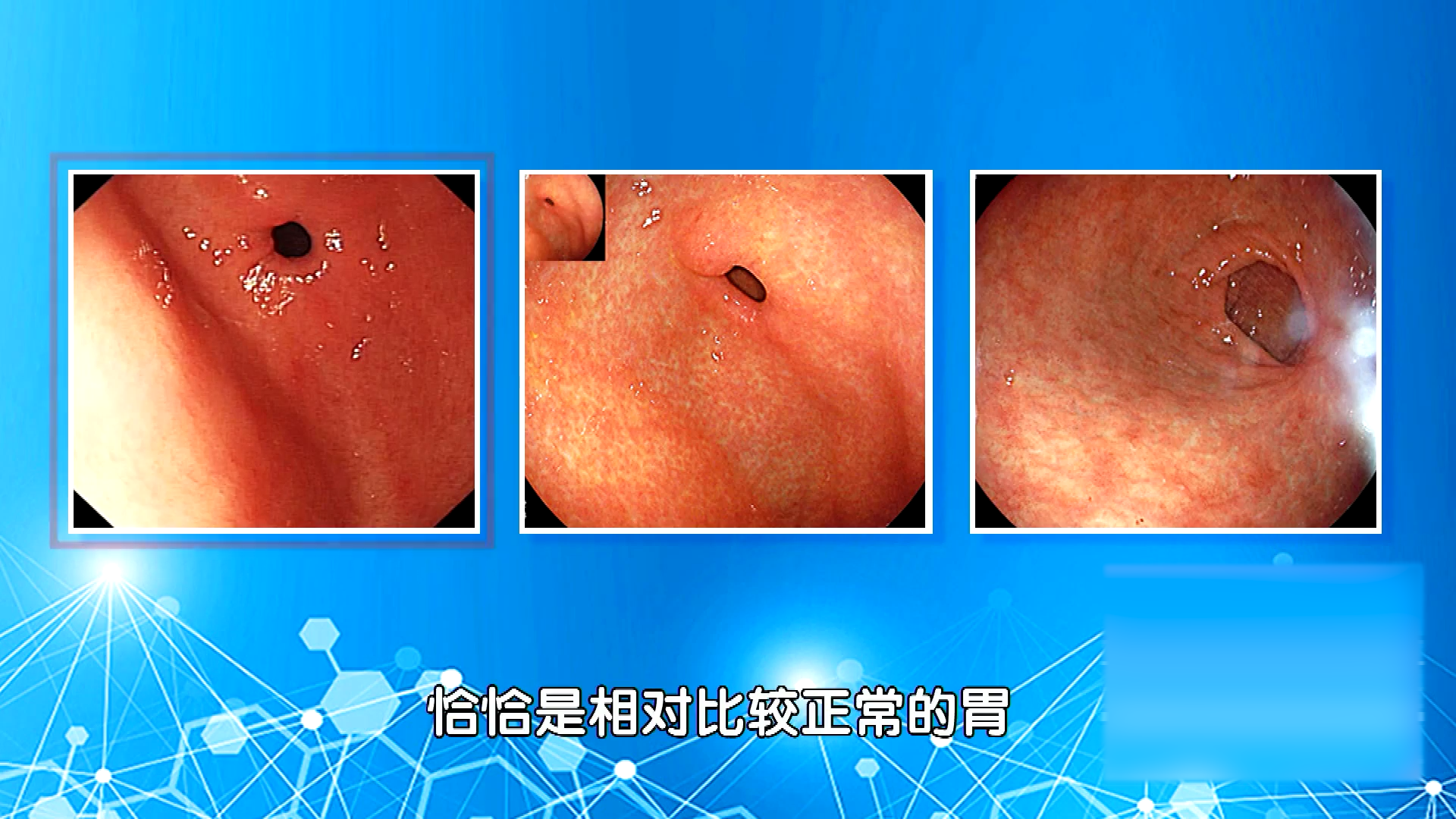 胃镜图像对比，你认识“最火热”的胆汁反流性胃炎吗？
