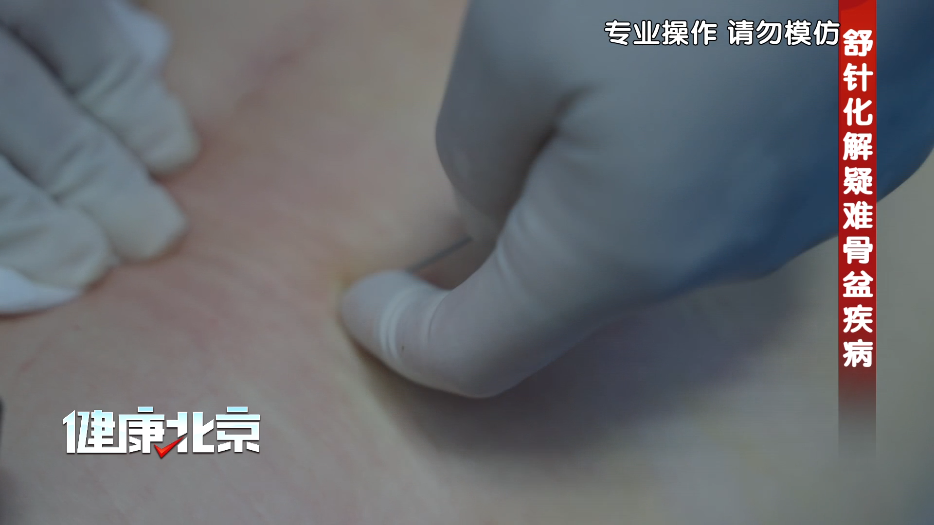 开过刀的腰又变形?几个针眼便可快速松解! 开过刀的腰又变形?几个针眼便可快速松解!