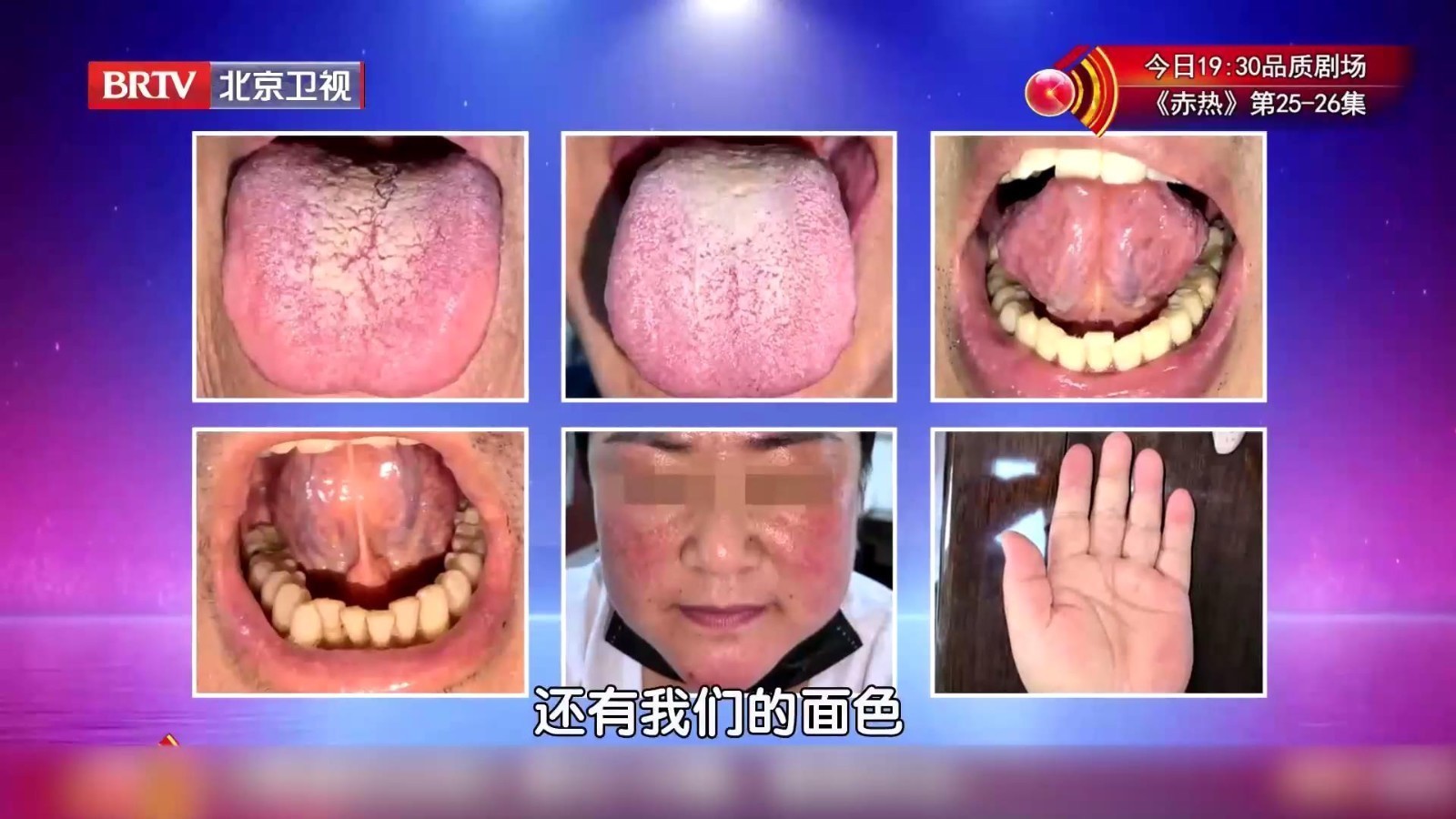 现场教学！看看舌象、面色，来判断自己的高血压属于实证还是虚证