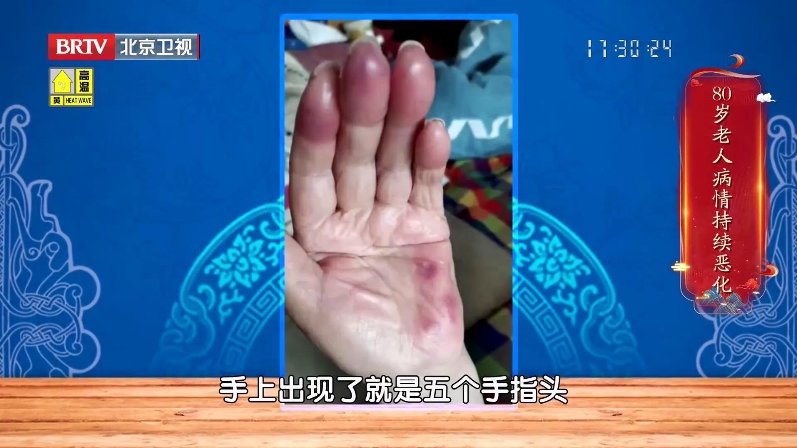 80岁老人高烧一周后，继发手指肿胀，持续进展一个月，根源竟是血瘀！