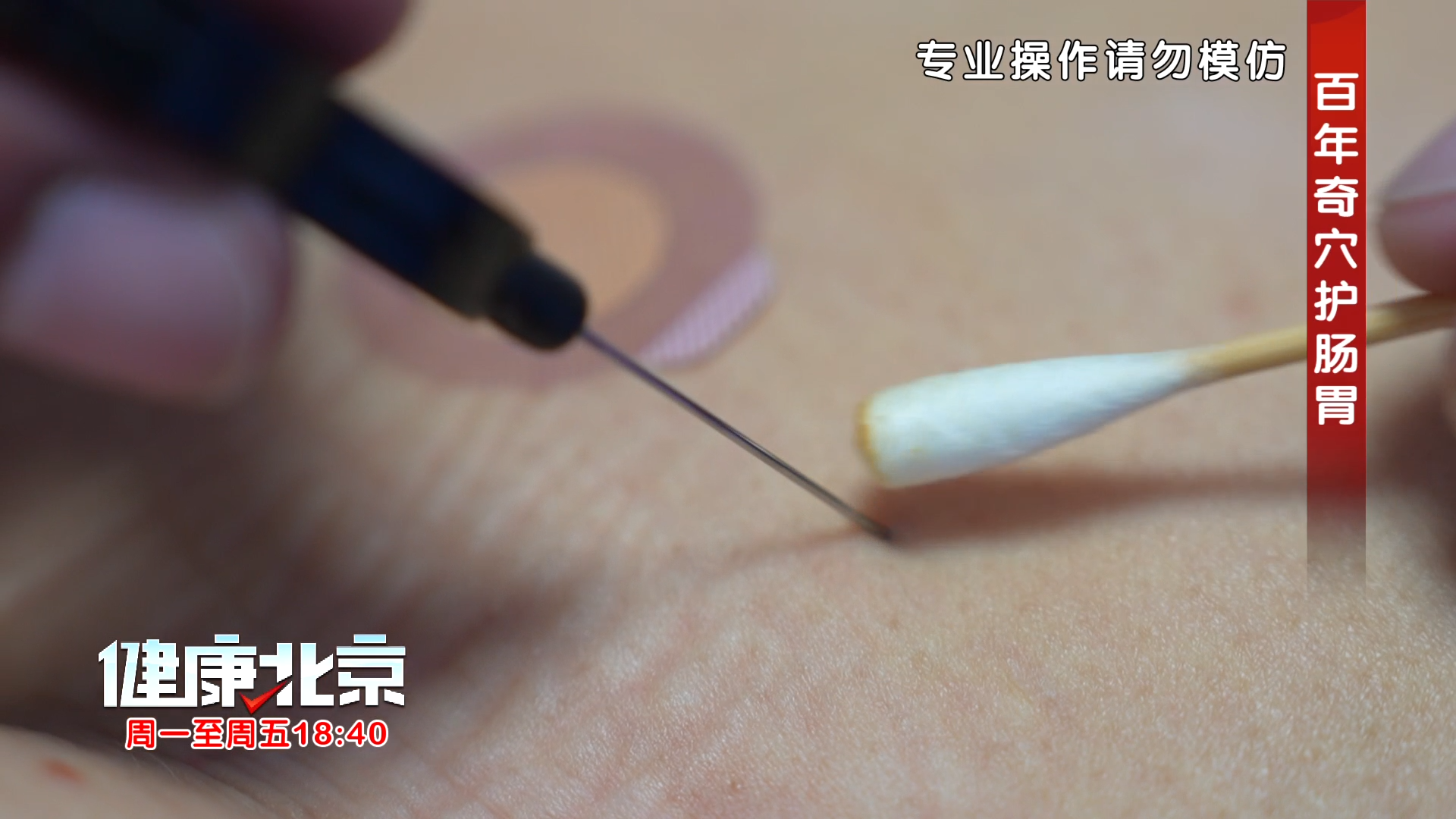 传承自光绪年间的奇穴疗法！一根线，调理肠胃半个月！