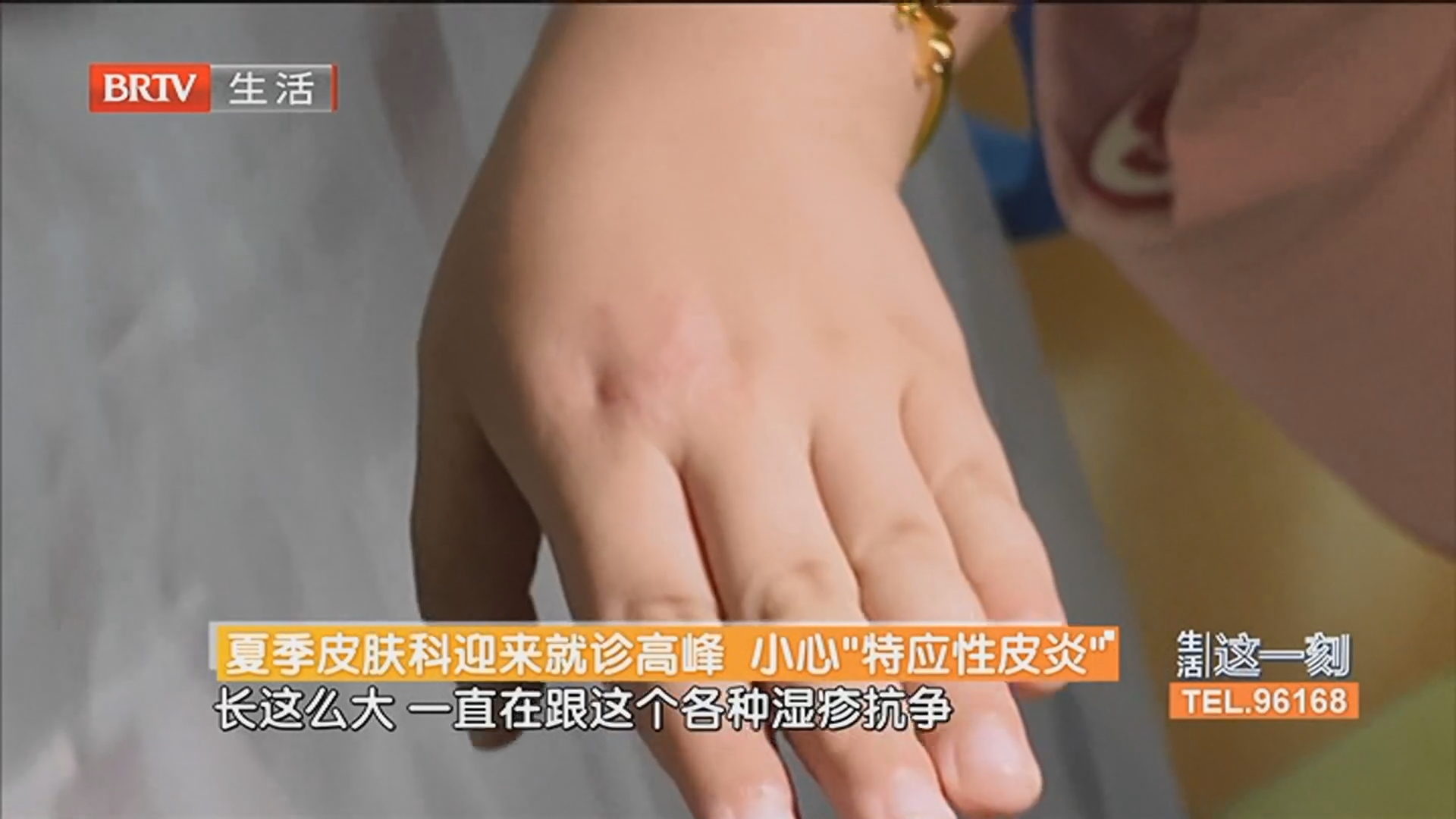 夏季皮肤科迎来就诊高峰 小心“特应性皮炎”